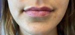 Lip Filler 6 After